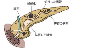 すい管拡張